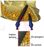 IMPLANT KONTACTTM Analyse par éléments finis des contraintes et déformations dans le cas d'un système 4-Load au maxillaire avec deux implants ...