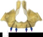 IMPLANT KONTACTTM Analyse par éléments finis des contraintes et déformations dans le cas d'un système 4-Load au maxillaire avec deux implants ...