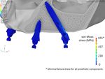 IMPLANT KONTACTTM Analyse par éléments finis des contraintes et déformations dans le cas d'un système 4-Load au maxillaire avec deux implants ...