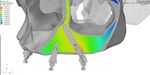 IMPLANT KONTACTTM Analyse par éléments finis des contraintes et déformations dans le cas d'un système 4-Load au maxillaire avec deux implants ...