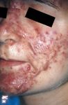 Item 232 : Dermatoses faciales : acn&eacute; - Coll&egrave;ge National des Enseignants de Dermatologie