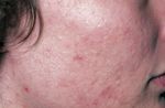 Item 232 : Dermatoses faciales : acn&eacute; - Coll&egrave;ge National des Enseignants de Dermatologie