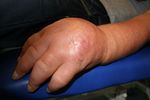 UN OED&Egrave;ME QUI R&Eacute;SISTE QUAND FAIRE APPEL AU PSYCHIATRE - DR MED MICH&Egrave;LE DEPAIRON, DR MED MARIA IAKOVA, DR MED JEAN SAVOY 14&Egrave;ME CONGR&Egrave;S DE LA SAFW ...