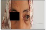 Cas clinique : Kyste hydatique orbitaire révélé par une exophtalmie Case report: Orbital hydatid cyst revealed by exophthalmos