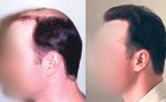 Traitement chirurgical des pertes de cheveux