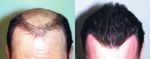 Traitement chirurgical des pertes de cheveux