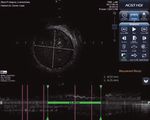 Système ACIST | HDi HD IVUS - Le système de prédilection pour l'imagerie optimisée - ACIST Medical Systems