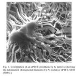 Infection de proth&egrave;se vasculaire