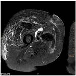Infection de proth&egrave;se vasculaire