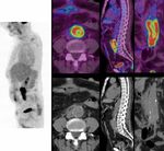 Infection de proth&egrave;se vasculaire