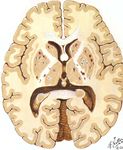 STROKE SUB-SAHARAN AFRICA - Epidemiology, Types, Management