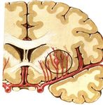 STROKE SUB-SAHARAN AFRICA - Epidemiology, Types, Management