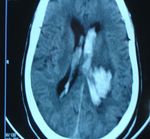 STROKE SUB-SAHARAN AFRICA - Epidemiology, Types, Management