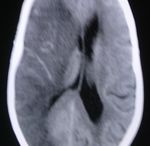 STROKE SUB-SAHARAN AFRICA - Epidemiology, Types, Management