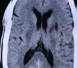 STROKE SUB-SAHARAN AFRICA - Epidemiology, Types, Management