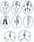 STROKE SUB-SAHARAN AFRICA - Epidemiology, Types, Management