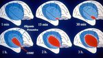 STROKE SUB-SAHARAN AFRICA - Epidemiology, Types, Management