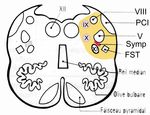 STROKE SUB-SAHARAN AFRICA - Epidemiology, Types, Management