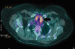 Cas cliniques et recommandations - Toxicit&eacute;s endocriniennes de l'immunoth&eacute;rapie Dr Amandine Berdelou