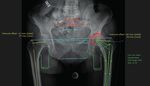 La planification numérique dans la Chirurgie endo prothétique de la hanche - Entretien avec le Professeur Philippe Massin