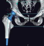 La planification numérique dans la Chirurgie endo prothétique de la hanche - Entretien avec le Professeur Philippe Massin