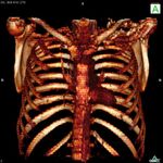 Sternectomie totale : proth&egrave;se de reconstruction sternale sur mesure - GASCON Audrey JEAN Claire LECA Marion