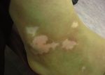 Retentissement psychosocial du vitiligo et des autres dépigmentations cutanées