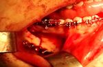Cas clinique / Case report - Approche ortho-chirurgicale d'une latéro dysmorphose mandibulaire : A propos d'un cas clinique Orthodontic-surgical ...